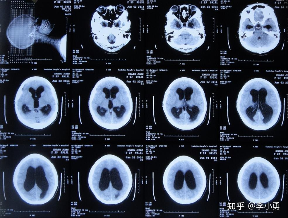 檢查ct後發現有腦積水(圖-1),再查頭顱核磁(圖-2)後認為是