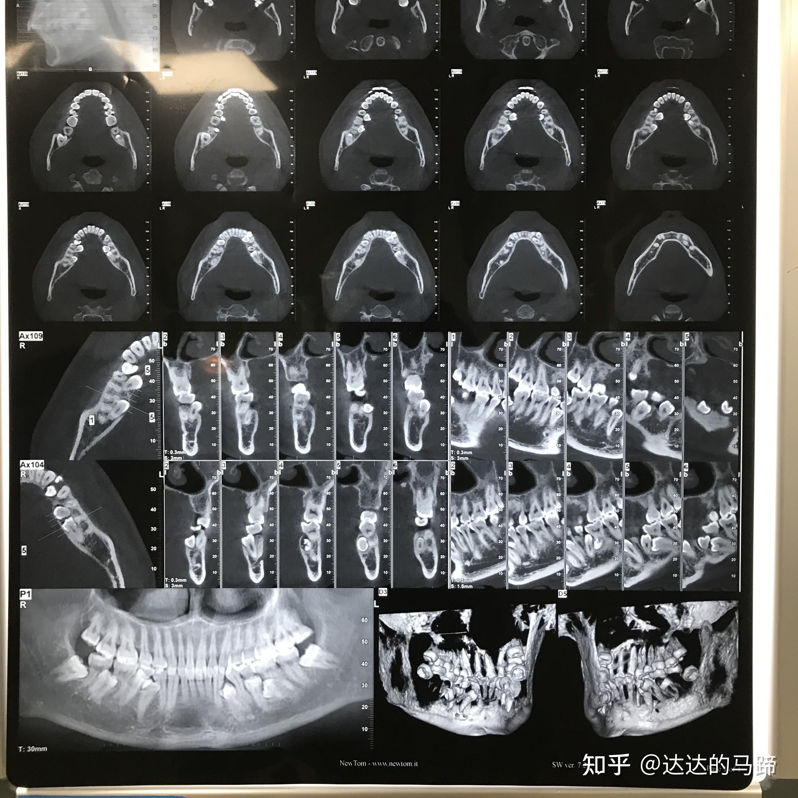 拔除十三顆牙智齒多生牙的全過程經歷及注意事項分享