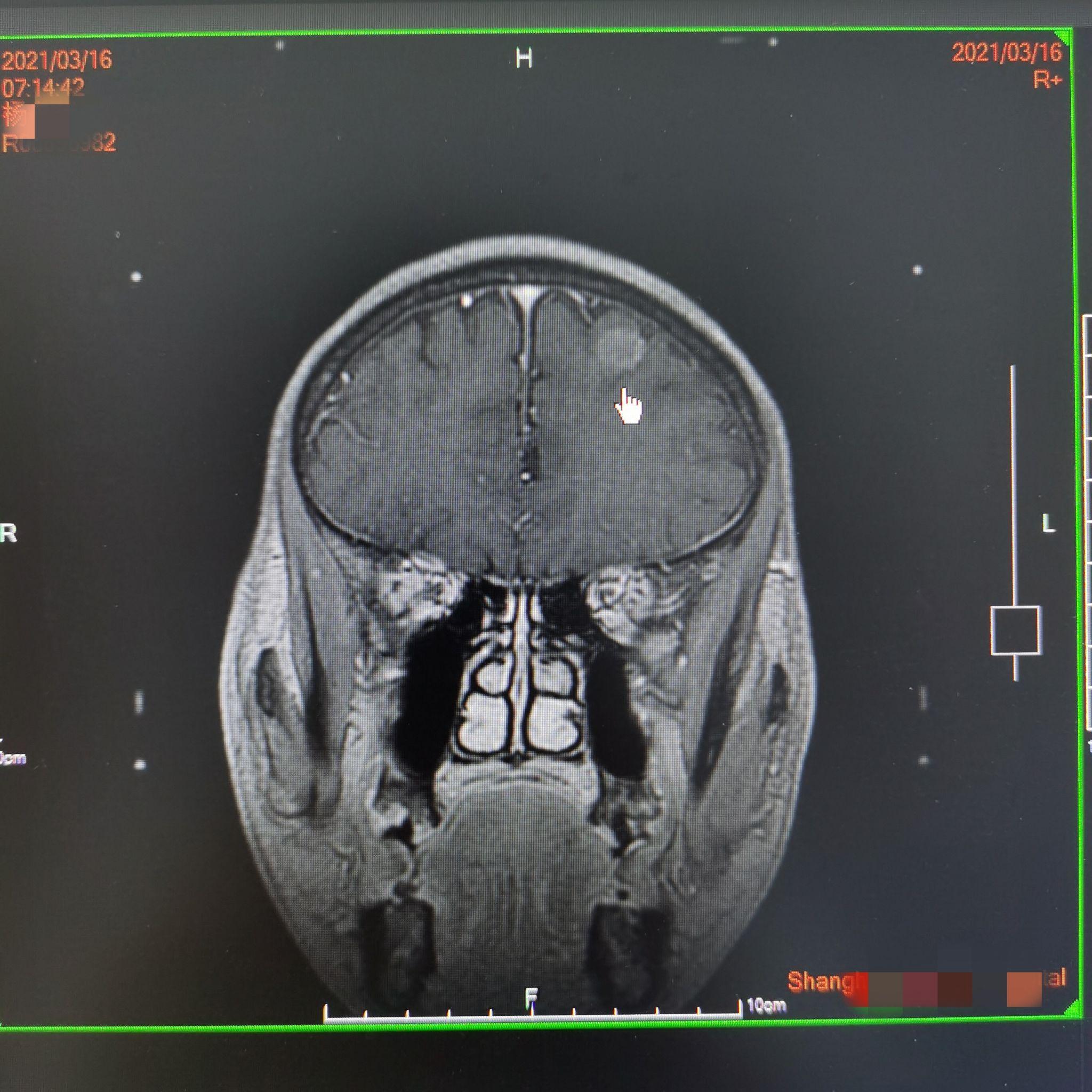 脑部肿瘤核磁共振照片图片
