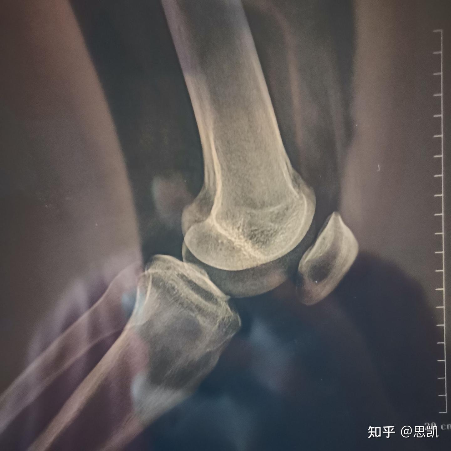 骨骺线闭合了吗？ - 知乎
