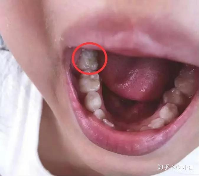 孩子窝沟封闭的最佳年龄,错过了小心孩子苦一辈子! - 知乎