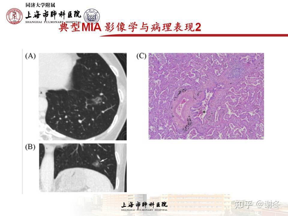 微浸润腺癌图片