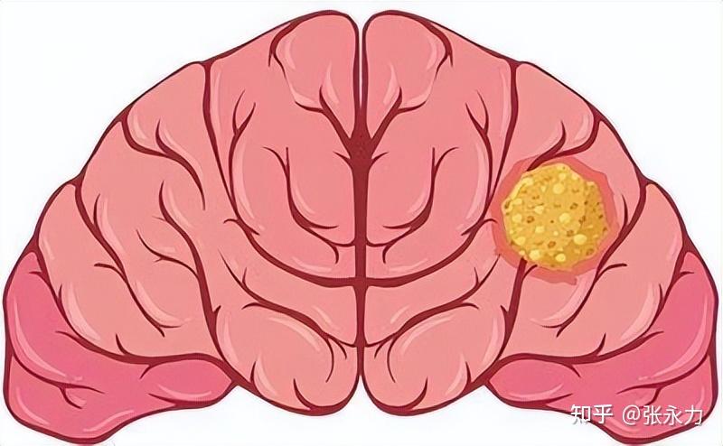 颅内肿瘤卡通图片图片