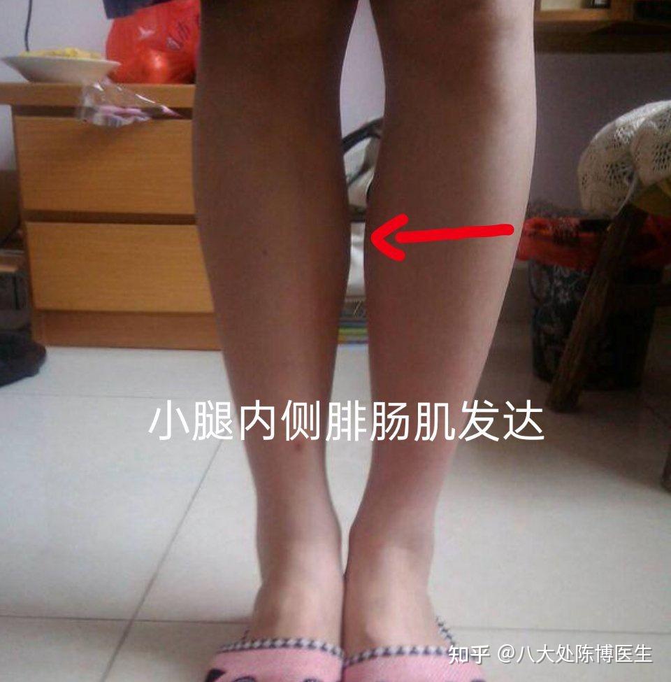 3,小腿内外侧腓肠肌都发达(如图3)比"独宠"更可怕的是"雨露均沾"!