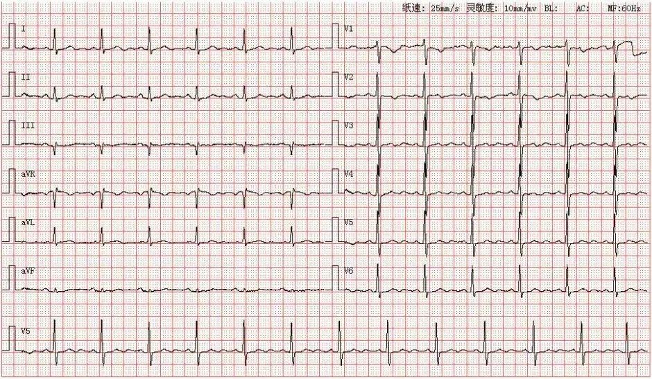 心电图u波明显图片