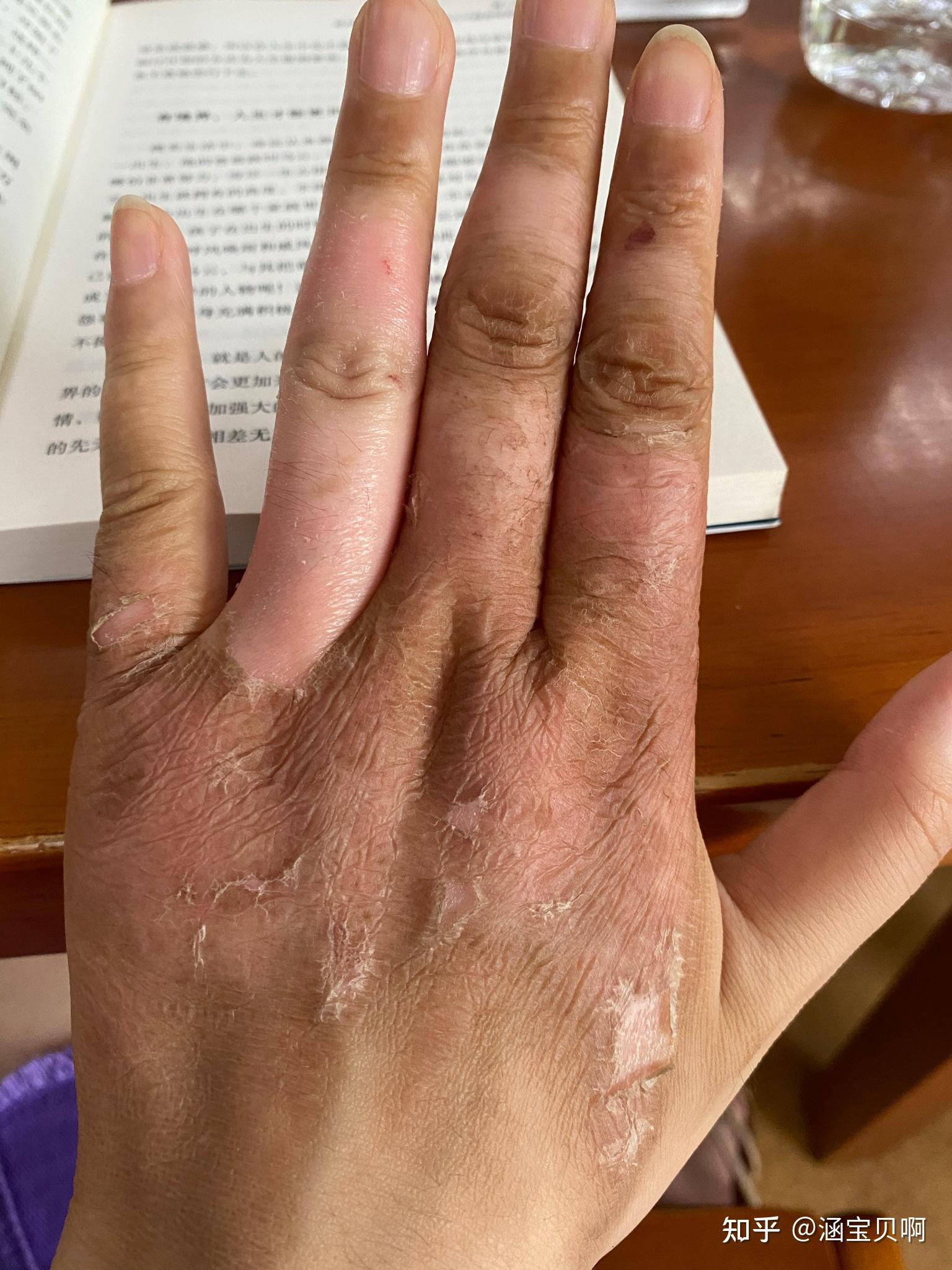 蒸汽烫伤处理 恢复过程 - 知乎