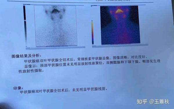 聊聊关于碘131二三事 - 知乎