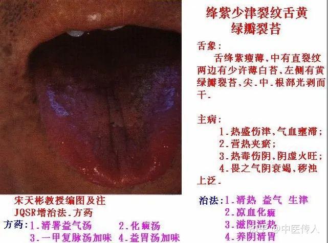 高清舌诊图解:各种临床证型舌象图谱大开眼界 - 知乎