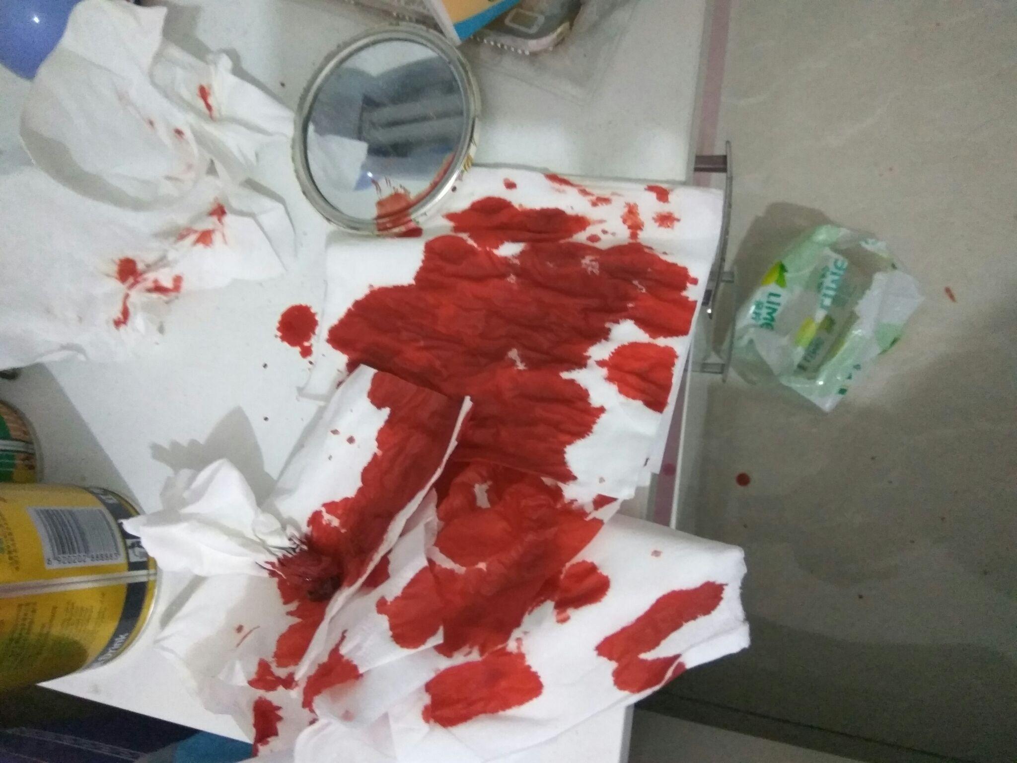 为什么感冒了会流鼻血? - 鼻炎 - 知乎