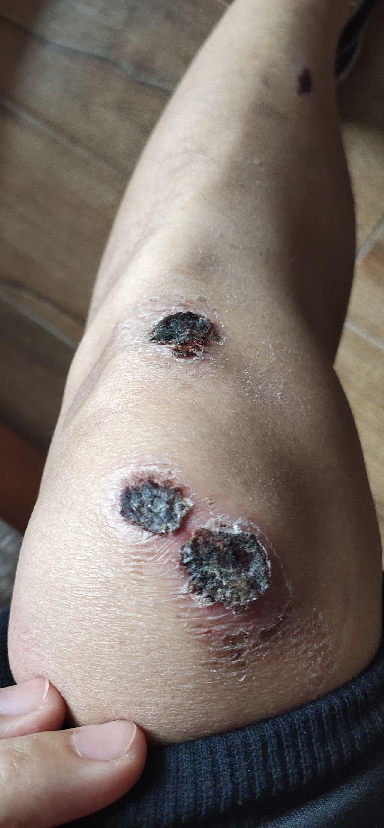 膝盖大面积擦伤