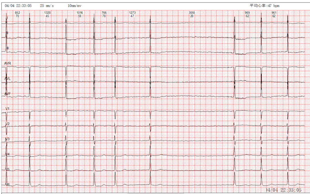 心房颤动伴长rr间期及散点图 心电图解读 欢迎大家走进心电图的世界 4