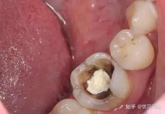深龋危害1,细菌感染:牙齿在镂空状态下容易积攒食物残渣,而且很难清理