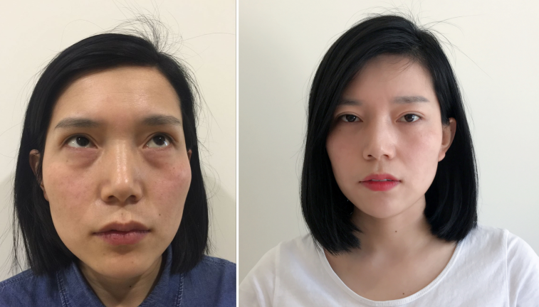 msqybzx;眼部年轻化医师 152 人 赞同了该文章 去眼袋手术实例照片,盗