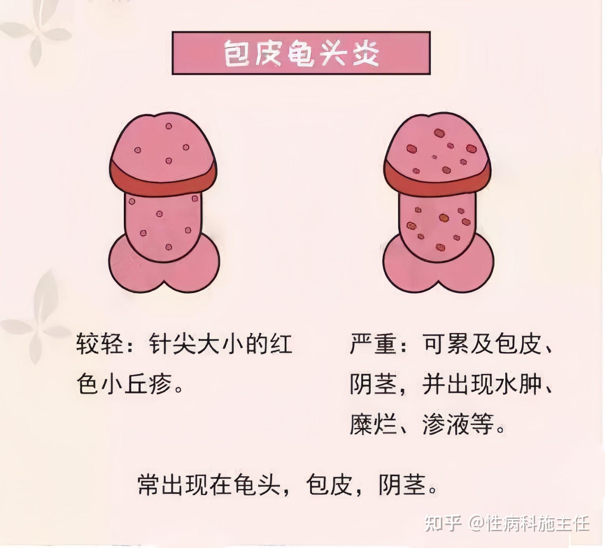 一,什么是包皮龟头炎?龟头炎是指阴茎头的炎症,包皮炎是指包皮的炎症.