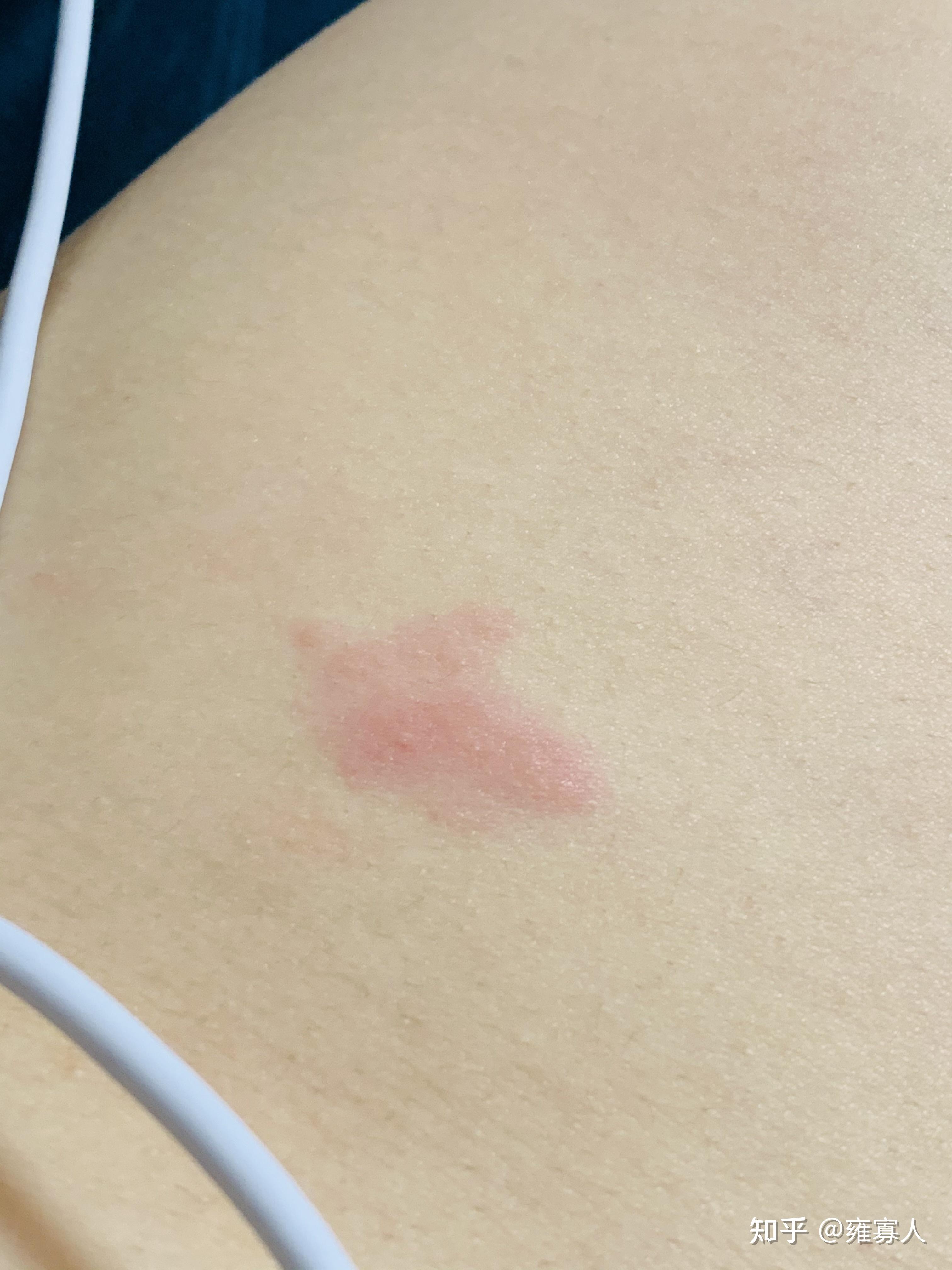 这是带状疱疹吗