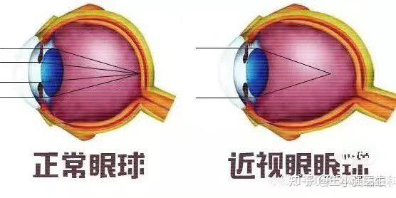 眼突和眼鼓的区别图片图片