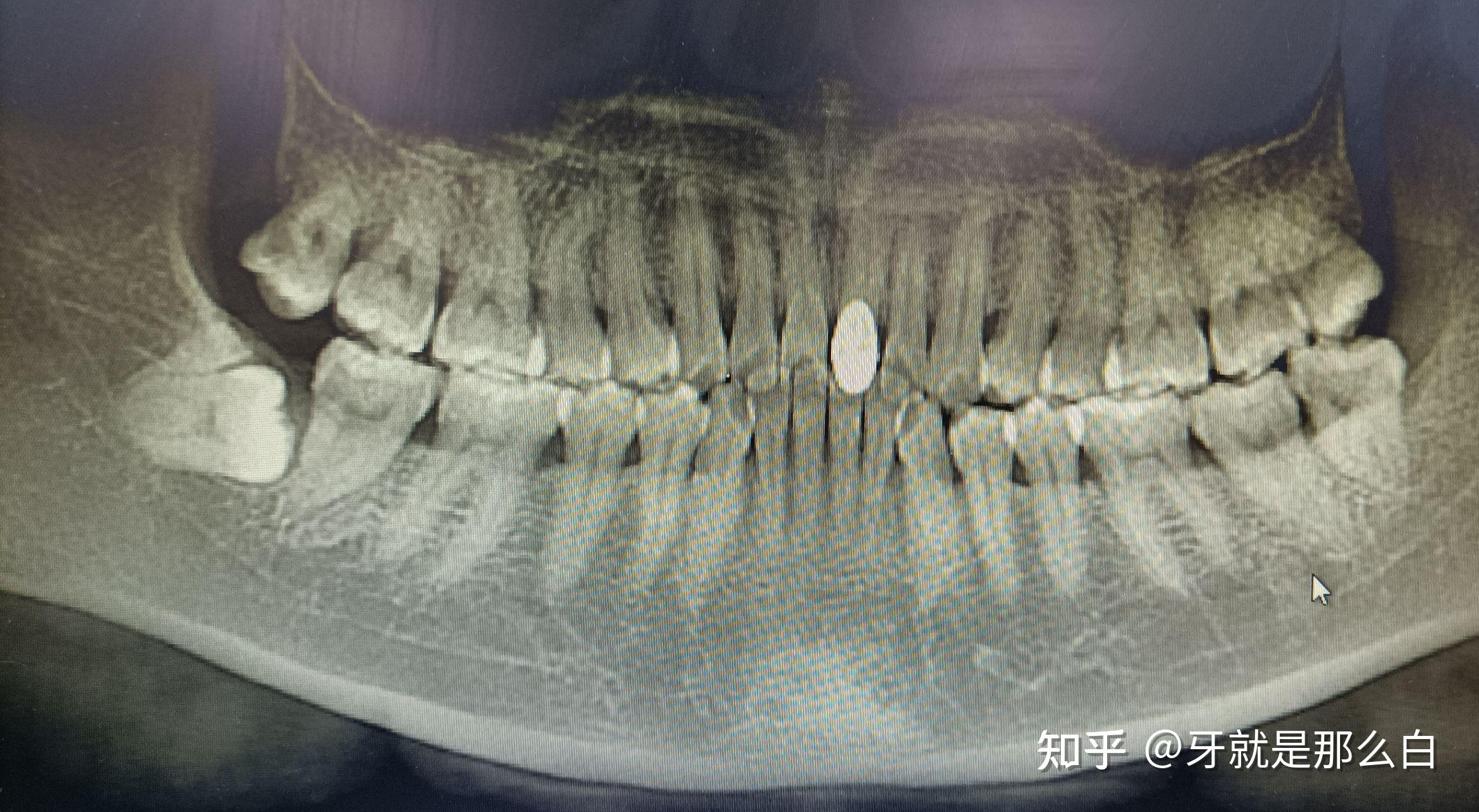 其次,智齒頂在前邊牙齒上,但是目前沒有症狀,智齒已經部分露出牙齦