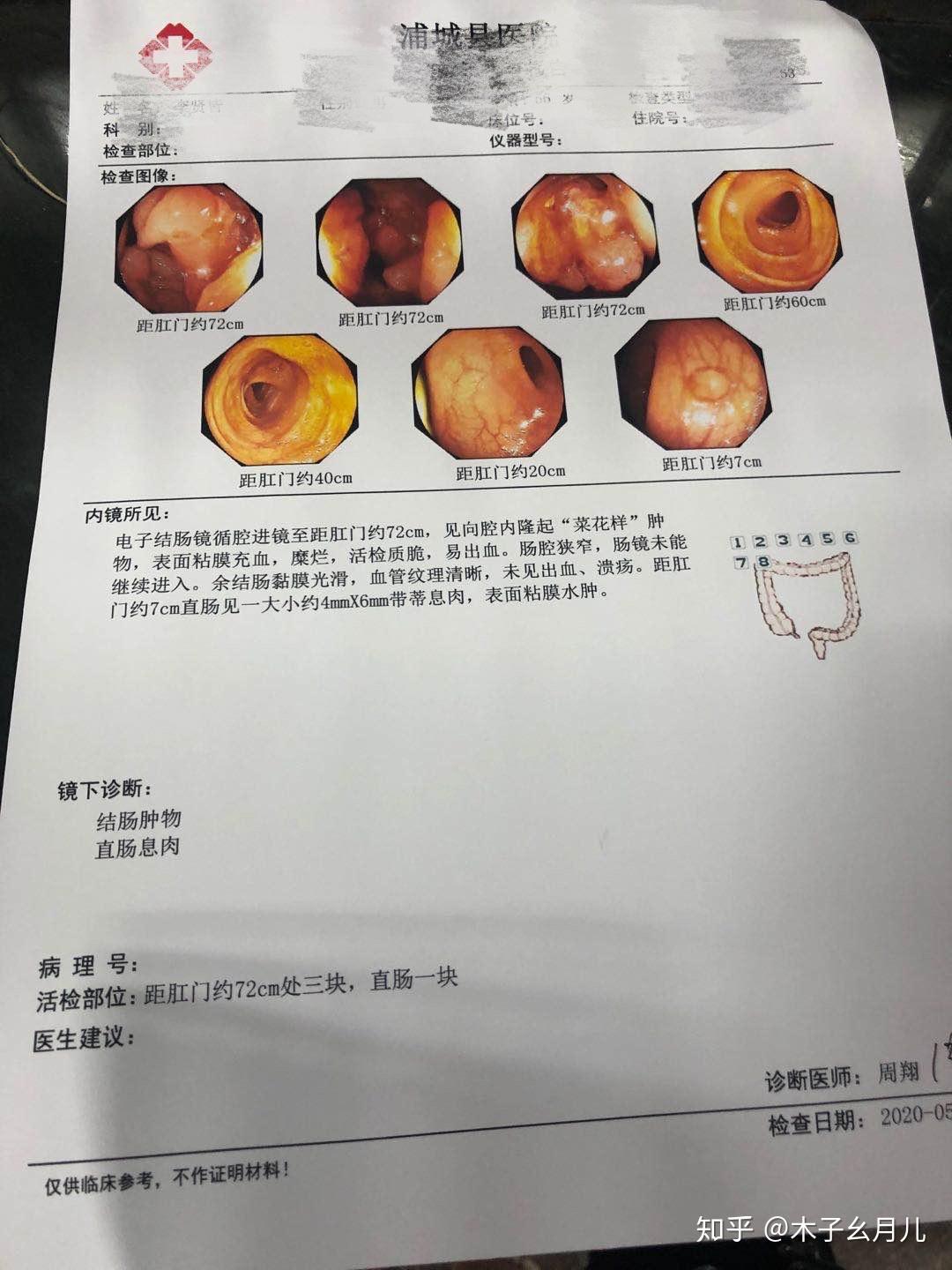 父亲抗癌全记录结肠癌