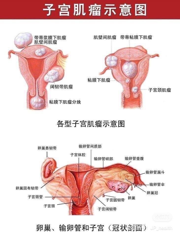子宫肌瘤可怕吗真的需要切除吗