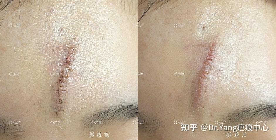 分享一例额部色脱疤痕拆线前后对比 - 知乎