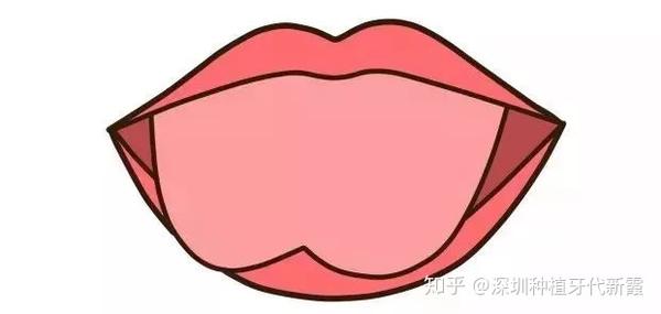 什么是舌系带短？这会有什么影响吗？该怎么判断舌系带短？孩子舌系带过短一定要剪掉吗？何时手术最好呢？ - 知乎