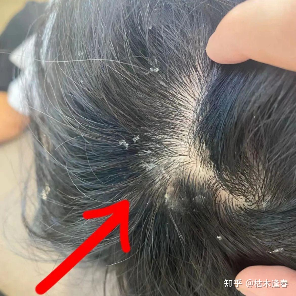 在皮肤科医生看来，拯救一个长期头皮屑泛滥的人，最快最好的方法是什么？ - 知乎