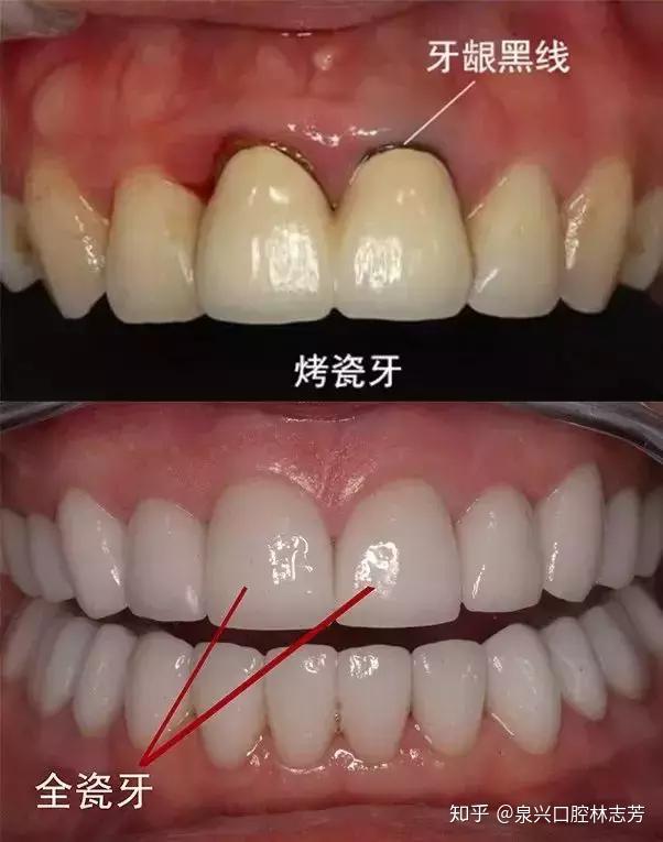 "瓜子牙"怎么修复?