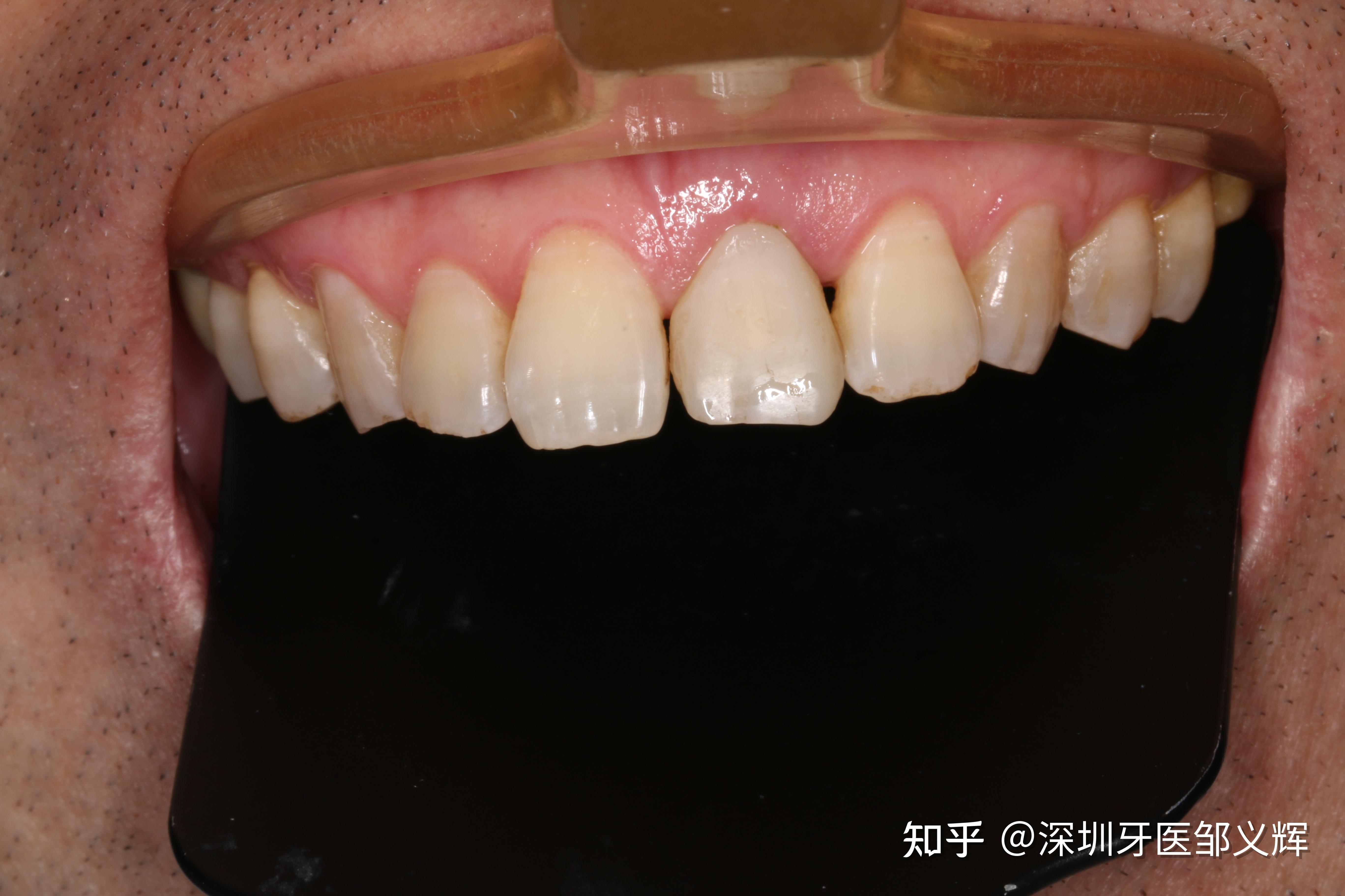 牙齿修复效果图图片素材-编号27341597-图行天下