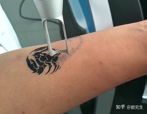 激光洗纹身会留下疤痕吗洗纹身疼吗