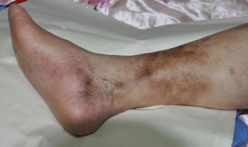 血管外科主任医师 5人赞同了该文章 上,下肢动脉闭塞症状表现: 上肢或