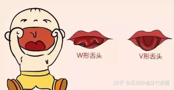 什么是舌系带短？这会有什么影响吗？该怎么判断舌系带短？孩子舌系带过短一定要剪掉吗？何时手术最好呢？ - 知乎
