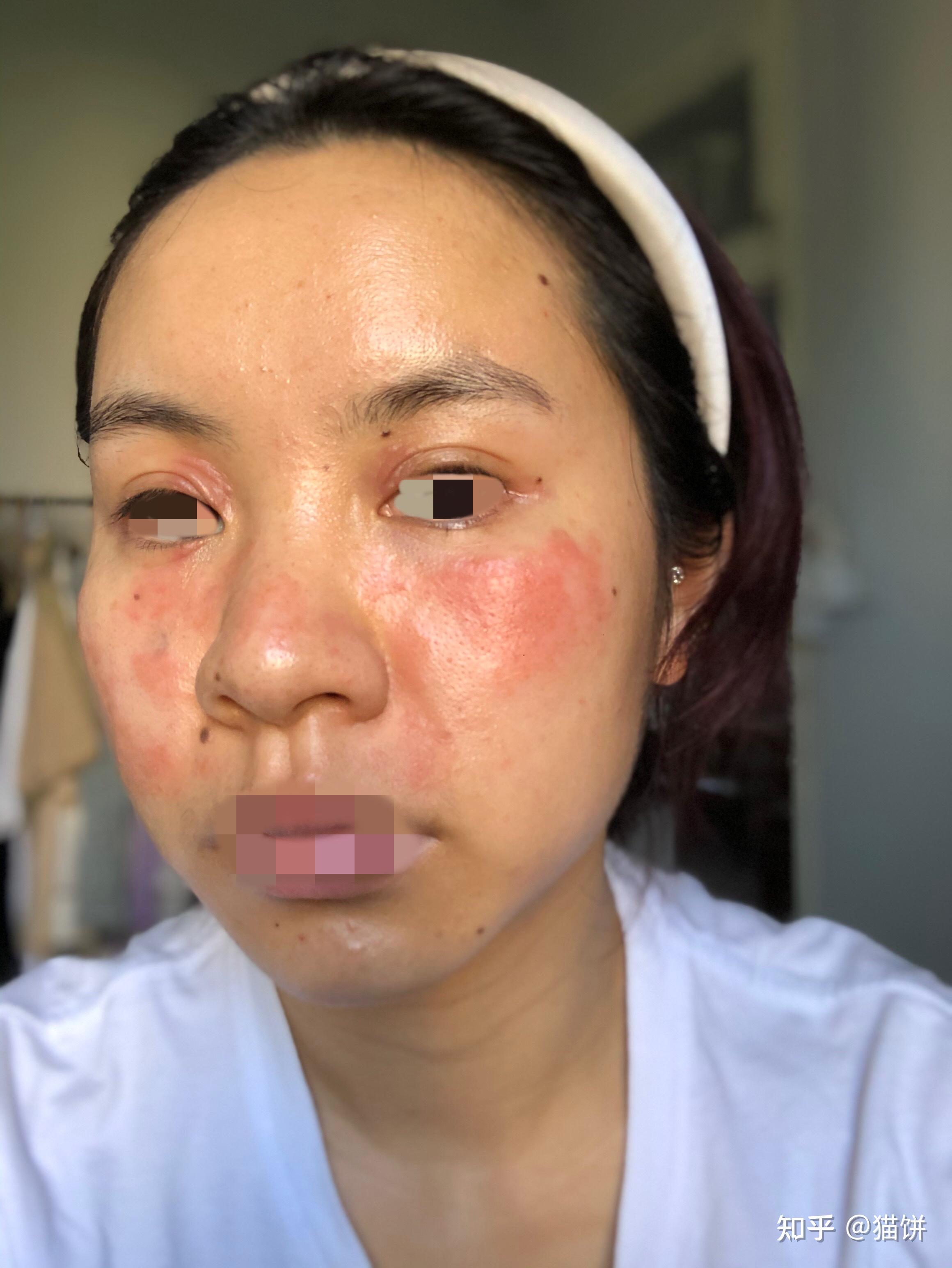 过敏7年的经历,从脂溢性皮炎到激素依赖性皮炎到过敏性鼻炎 过敏性