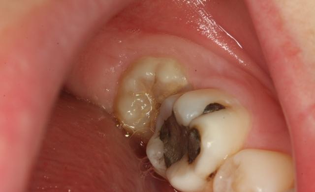 牙医烧哥 不为良相愿为良医 14人 赞同了该文章 首先不是每颗智齿的