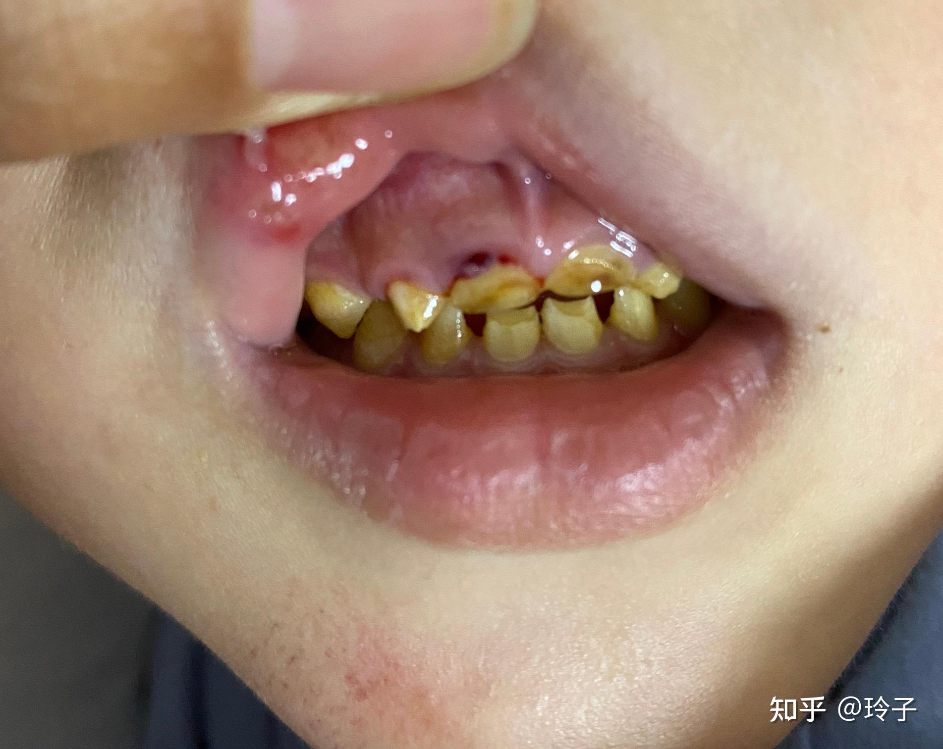 孩子牙釉质缺失,麻麻的焦虑症? 