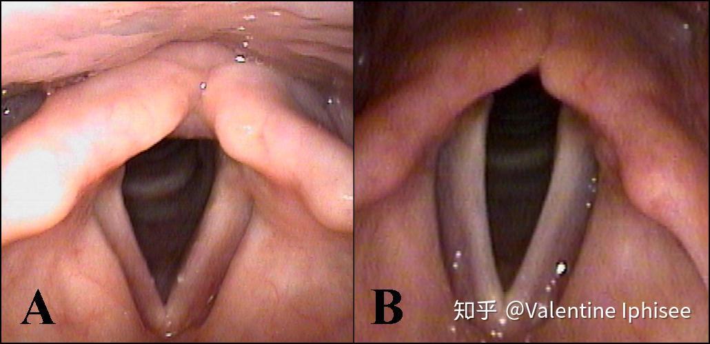 食管返流食道反流 食管返流食道反流