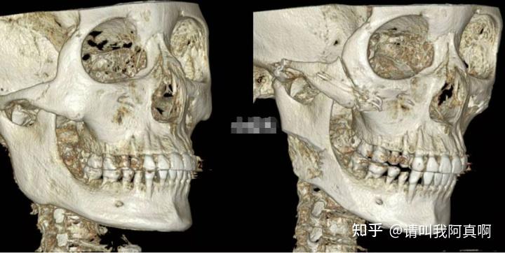 顴骨內推,顴弓手術後是會採用鈦釘進行固定.