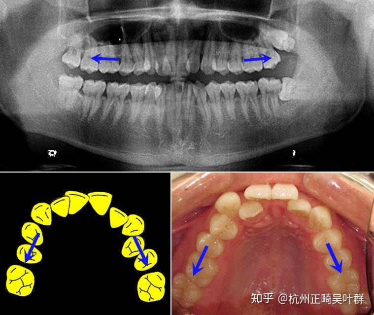 如果將齒弓後方大臼齒往後移動,的確可以增加排列牙齒之空間.