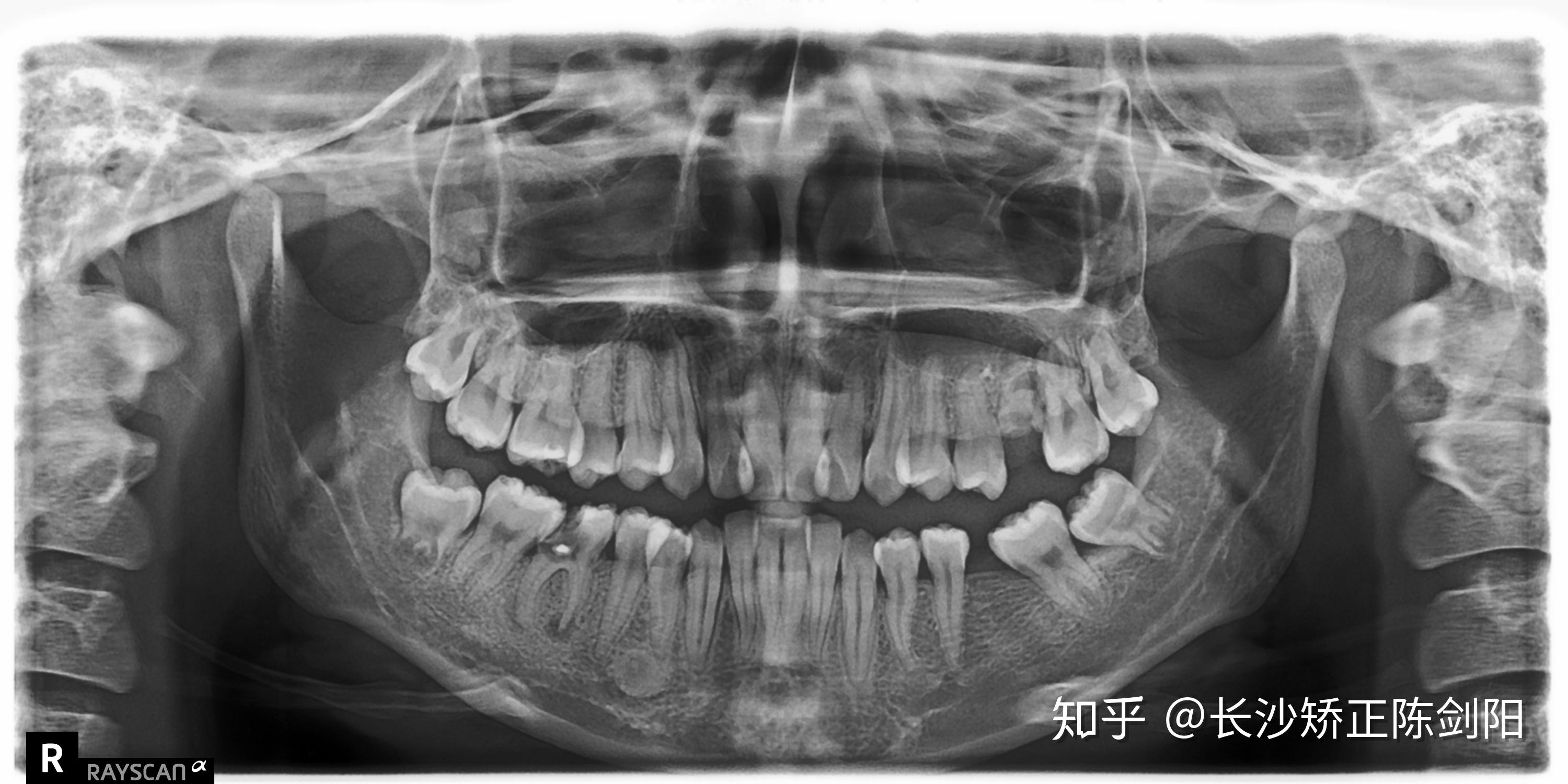 长沙牙齿矫正有蛀牙可以矫正牙齿吗