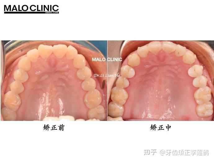 北京牙齒矯正丨嘴突閉唇緊張深覆合隱適美推磨牙向後