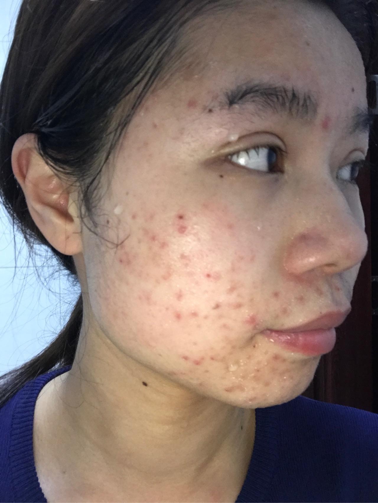 两腮,耳际,脖子与脸交接处反复长痘痘是什么原