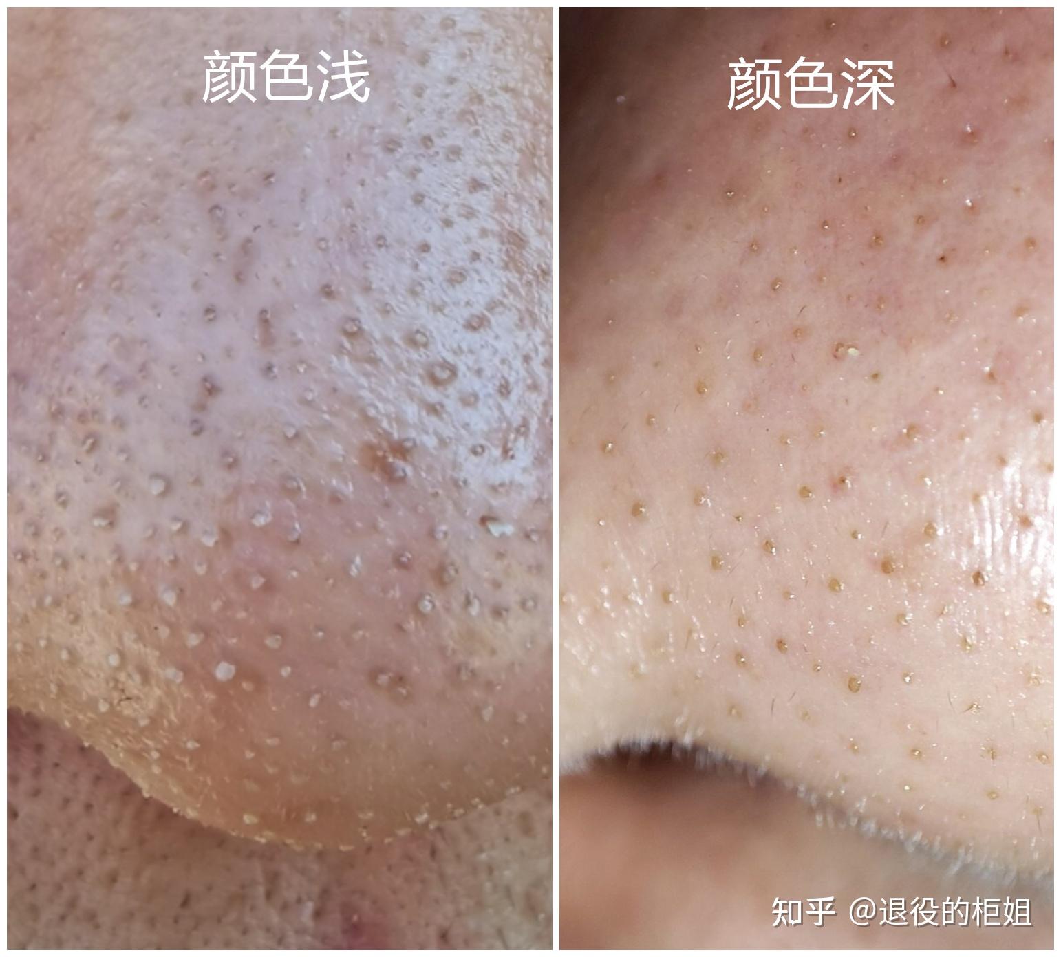 黑头的本质是什么?如何区别黑头? - 知乎