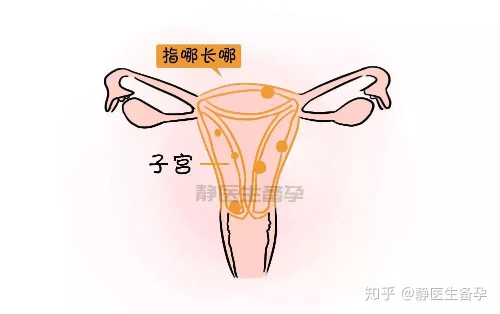 你知道嗎每5個女人就有1箇中招子宮肌瘤