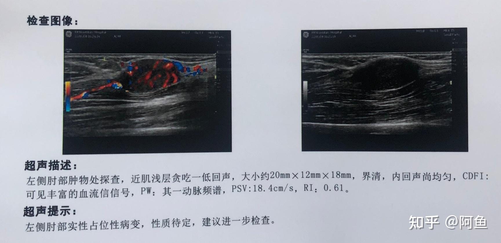 虚惊一场———结节性筋膜炎