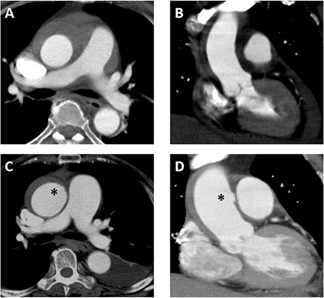 文献速递 | 急性a型主动脉壁内血肿的ct特征及临床意义