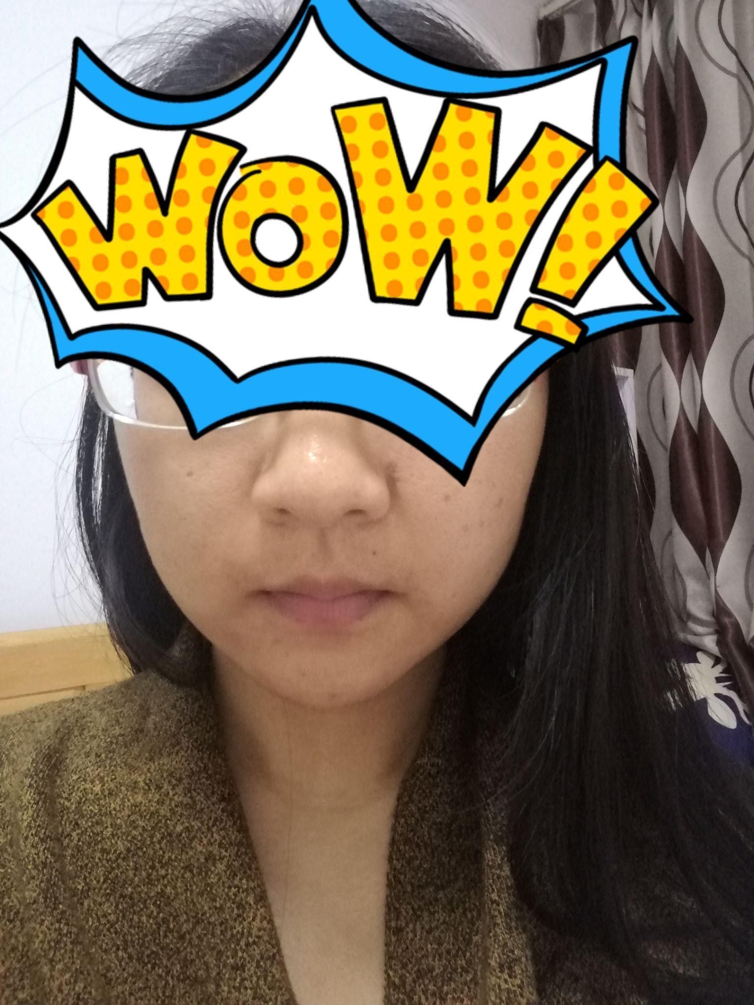 祛痣那些事儿:成都,激光祛痣+手术切痣