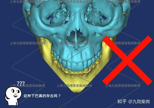 下巴天生并不是一条直线或斜线