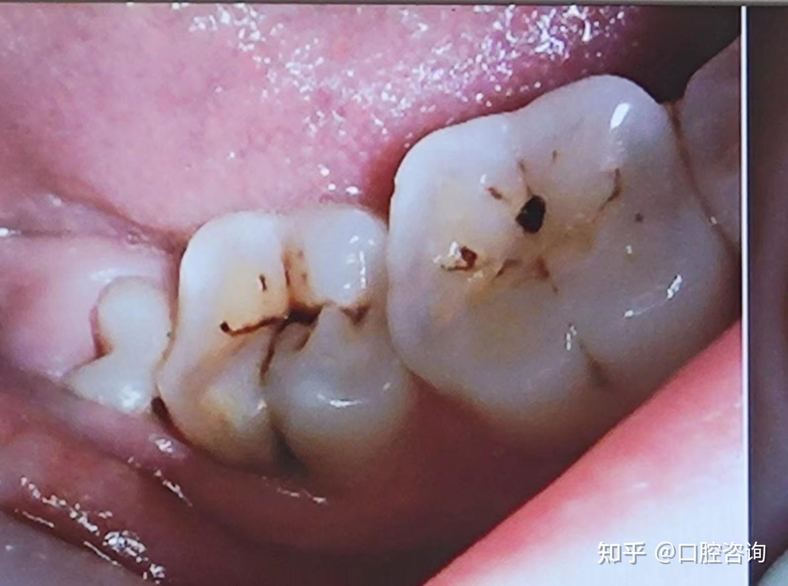 得了龋齿，什么情况可以直接补牙，什么情况又需要做根管治疗？ - 知乎