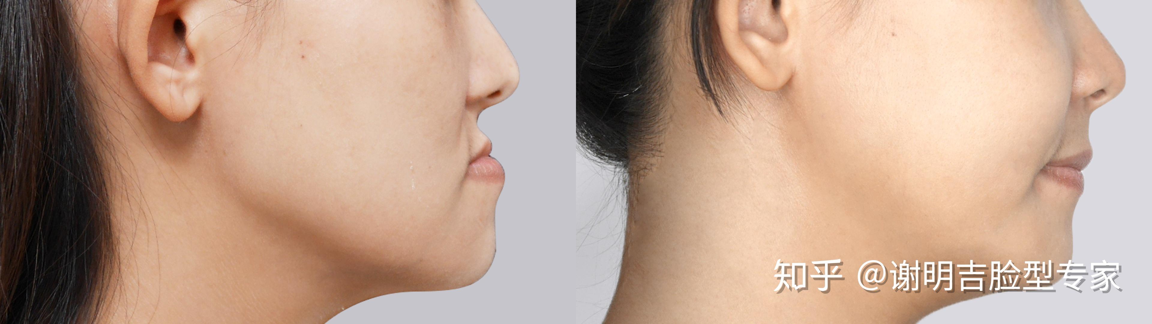 正颌篇| 网球小将 月亮脸美形晋级