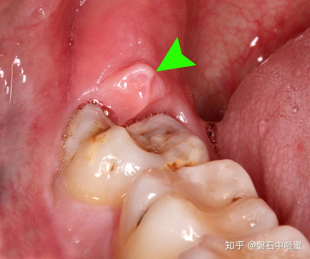 1最近左边牙齿牙龈（大概牙齿根部)有小白色突起，按压酸痛。2口腔溃疡4个。鼻塞头痛。_百度知道