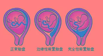 连接母婴生命线的胎盘异常，对母体和胎儿有什么影响？ - 知乎